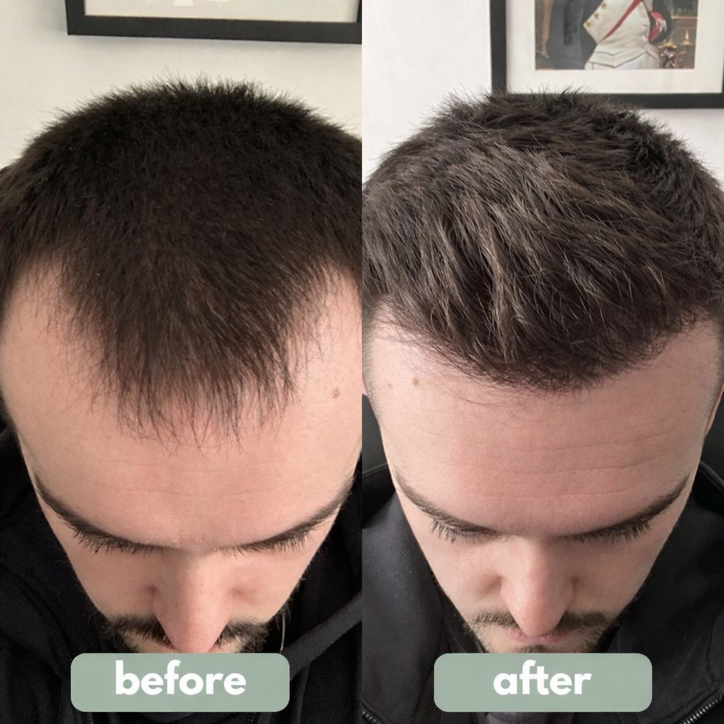 Spenix Reverse Hair Growth Serum – Thicker, Fuller Hair